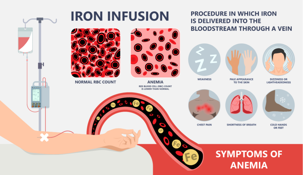 Ferinject Iron Infusion